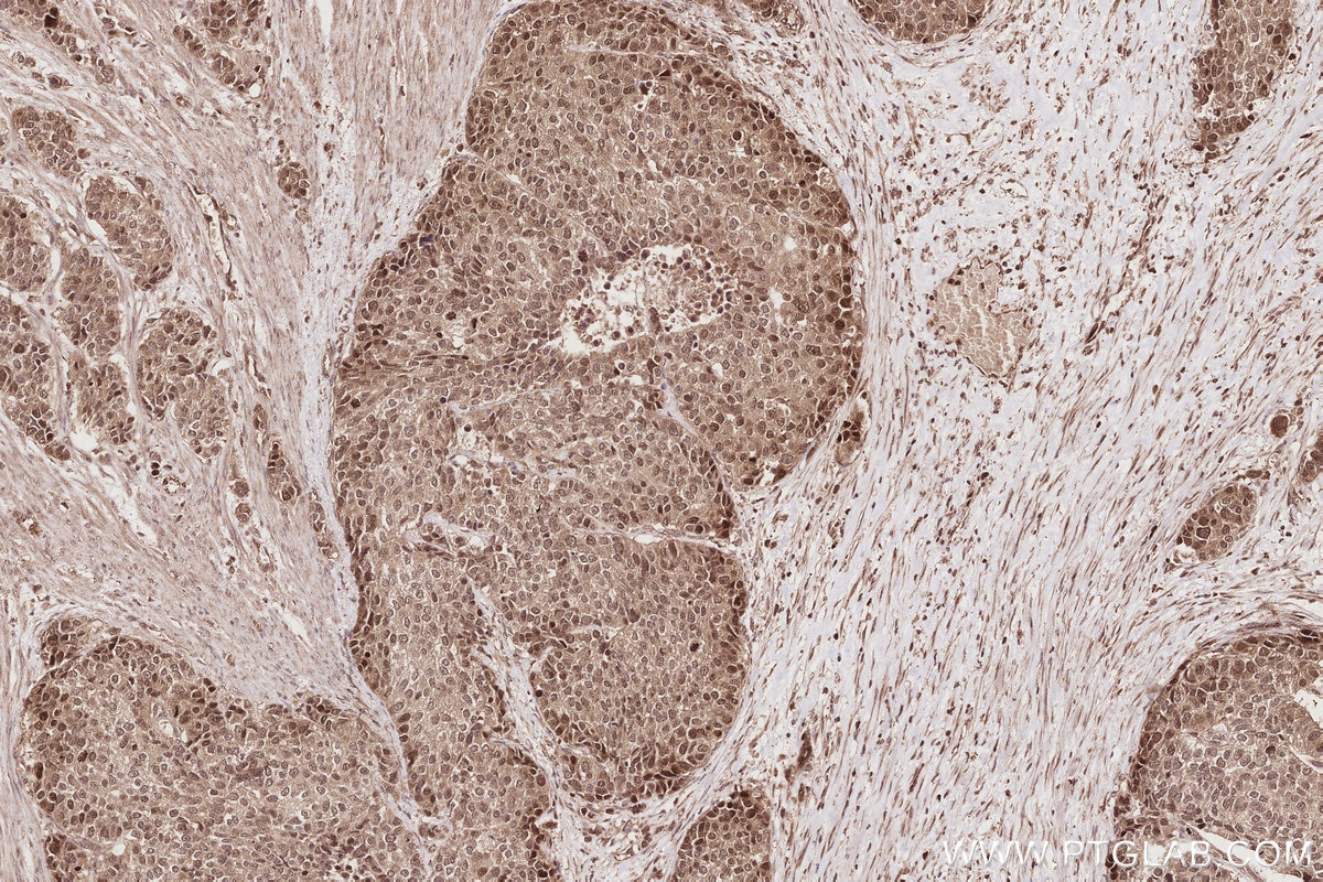 IHC staining of human stomach cancer using 28018-1-AP Immunohistochemistry (IHC) staining of human stomach cancer tissue using VRK1 Polyclonal antibody (28018-1-AP)