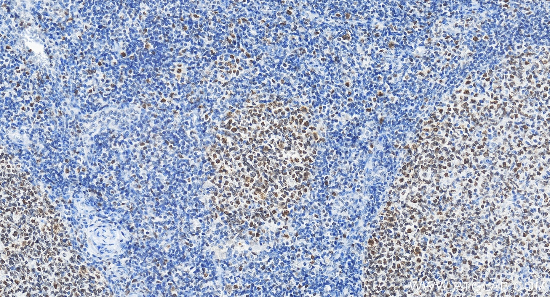 Immunohistochemical analysis of paraffin-embedded human tonsillitis tissue slide using 85598-2-RR (VRK1 antibody) at dilution of 1:800 (under 20x lens). Heat mediated antigen retrieval with Tris-EDTA buffer (pH 9.0). Immunohistochemistry (IHC) staining of human tonsillitis tissue using VRK1 Recombinant monoclonal antibody (85598-2-RR)