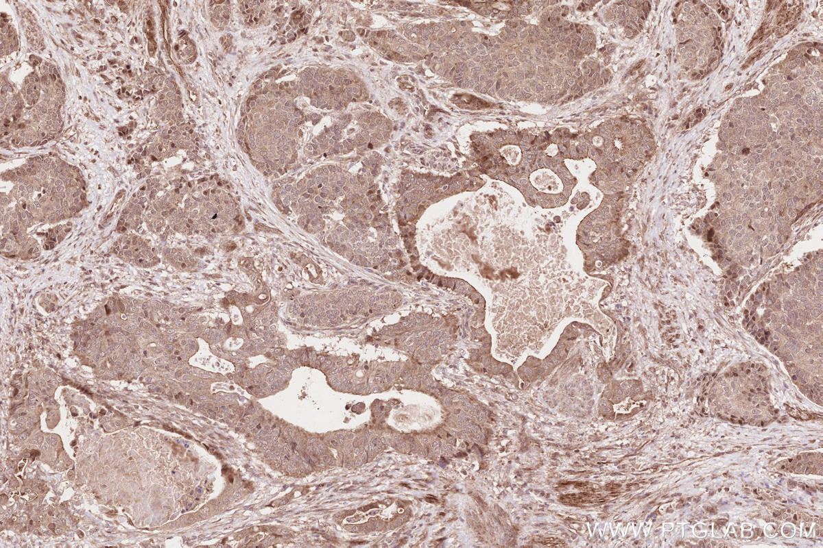 Immunohistochemistry (IHC) staining of human stomach cancer tissue using VRK2 Polyclonal antibody (12946-1-AP)