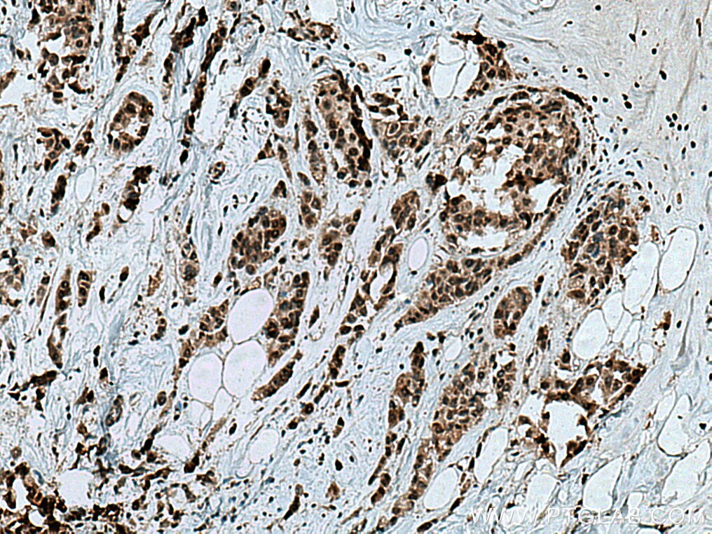 Immunohistochemistry (IHC) staining of human breast cancer tissue using VRK3 Polyclonal antibody (15608-1-AP)