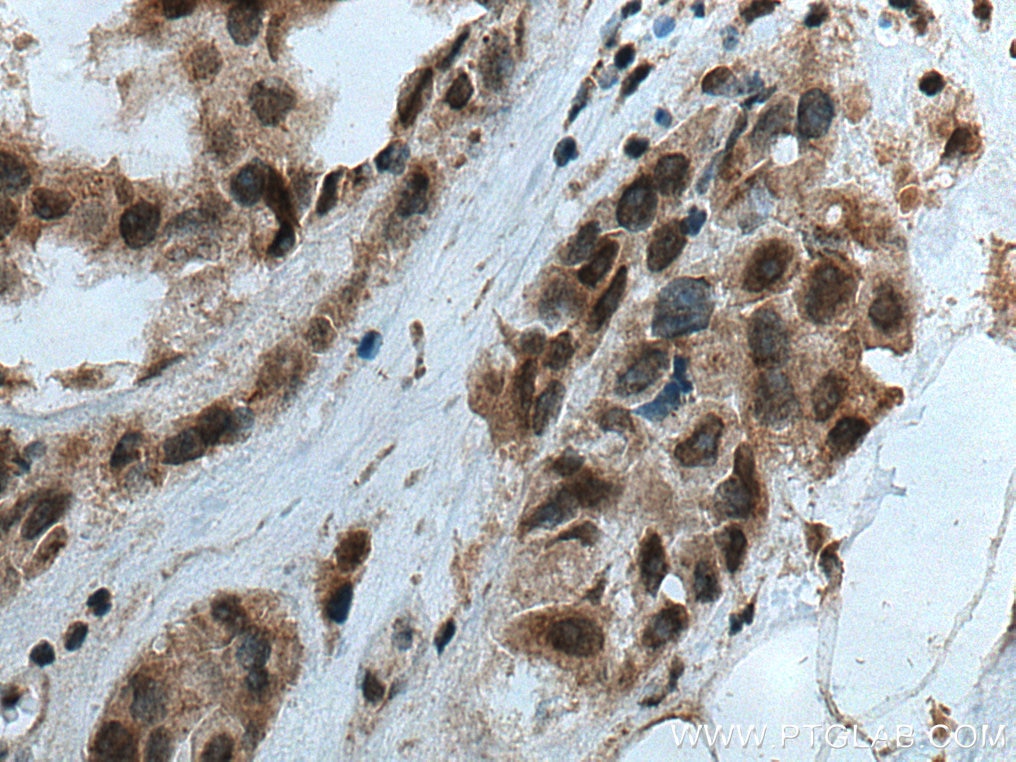 Immunohistochemistry (IHC) staining of human breast cancer tissue using VRK3 Polyclonal antibody (15608-1-AP)