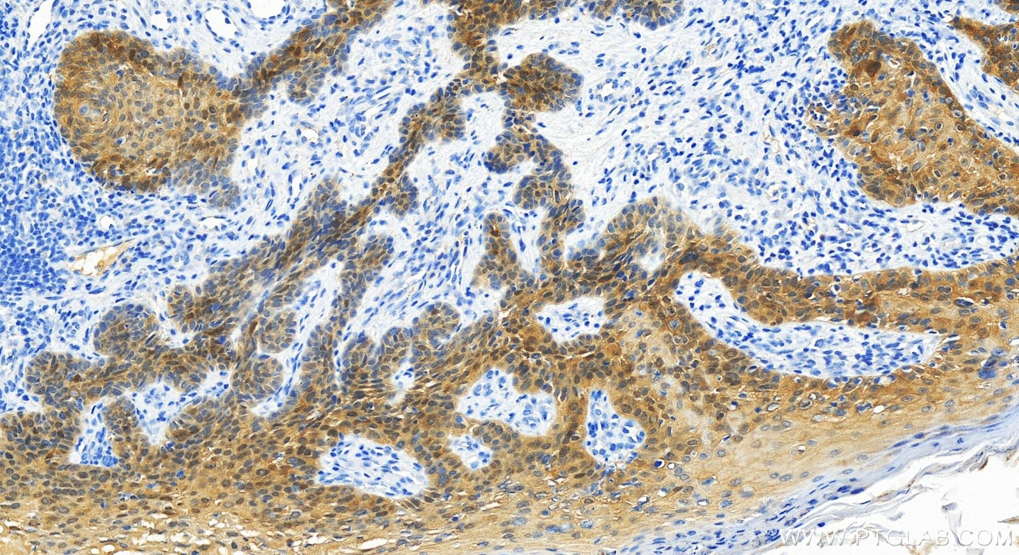 Immunohistochemistry (IHC) staining of Human bowens disease using VILIP-1 Polyclonal antibody (13919-1-AP)