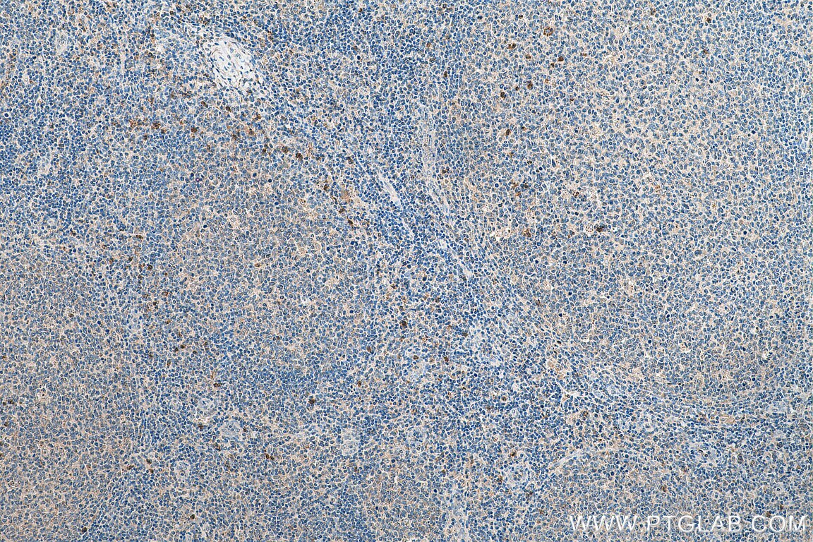 Immunohistochemistry (IHC) staining of human tonsillitis tissue using VSTM1 Polyclonal antibody (24382-1-AP)