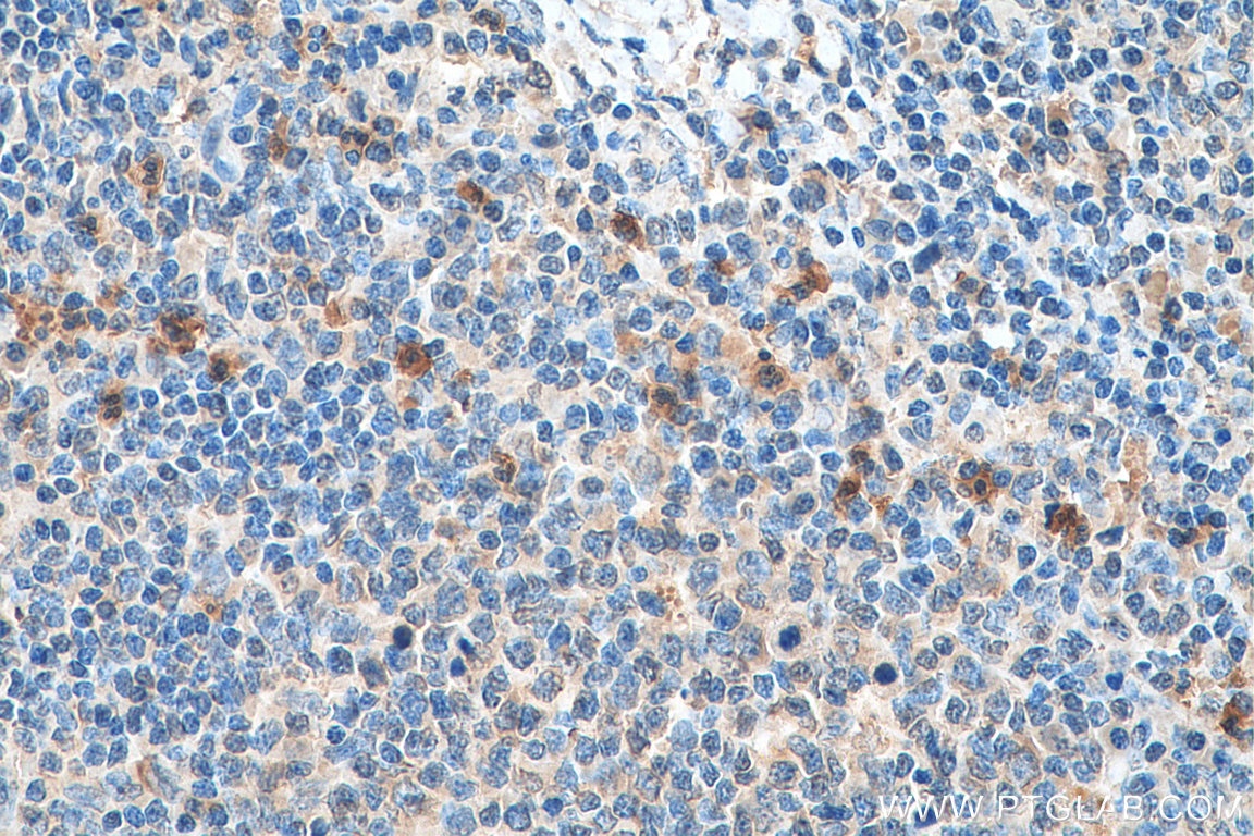 Immunohistochemistry (IHC) staining of human tonsillitis tissue using VSTM1 Polyclonal antibody (24382-1-AP)