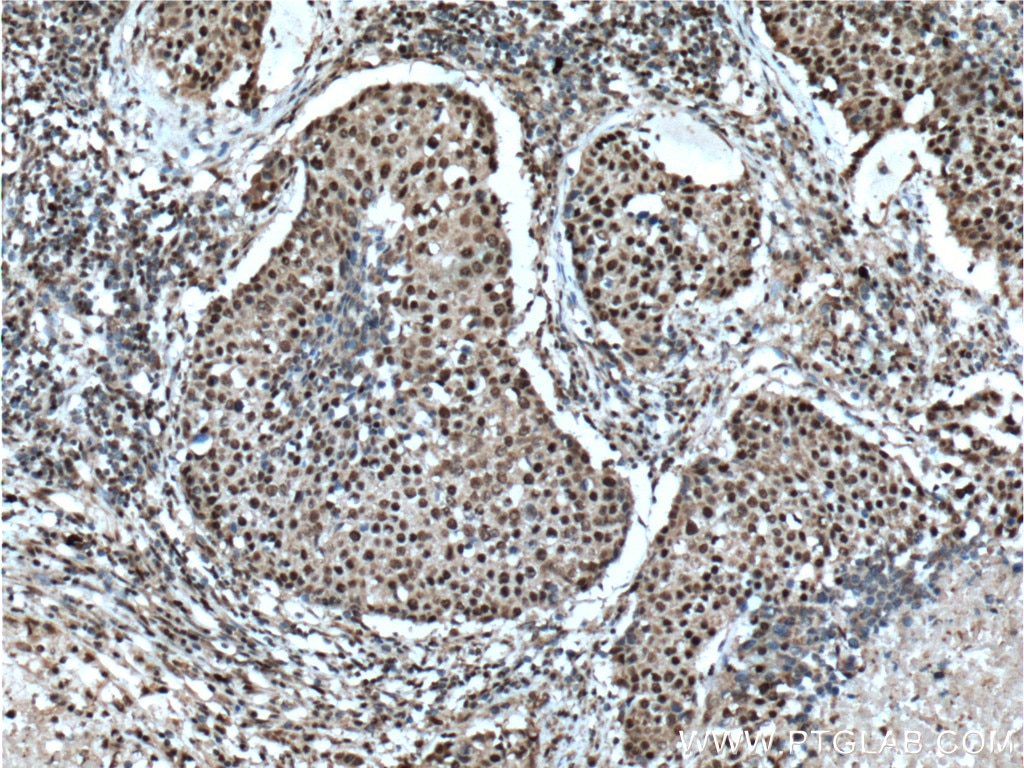 Immunohistochemistry (IHC) staining of human lung cancer tissue using VSX2 Polyclonal antibody (25825-1-AP)