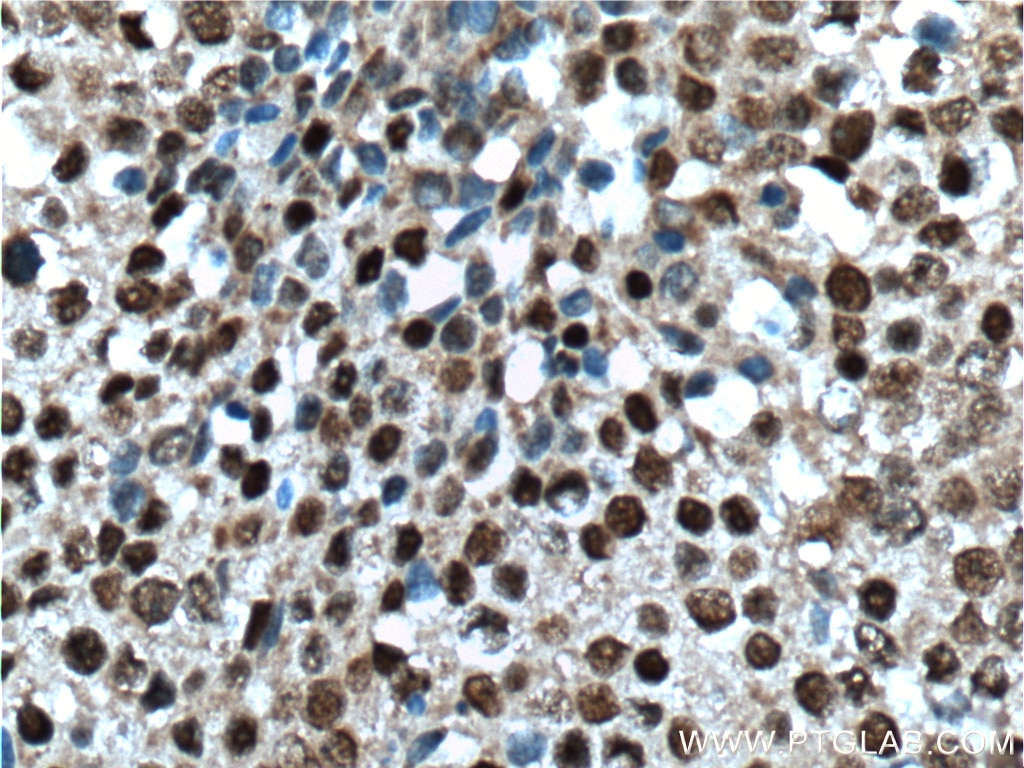 Immunohistochemistry (IHC) staining of human lung cancer tissue using VSX2 Polyclonal antibody (25825-1-AP)