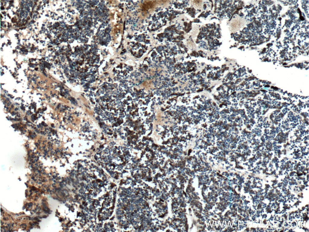 IHC staining of human retinoblastoma using 25825-1-AP