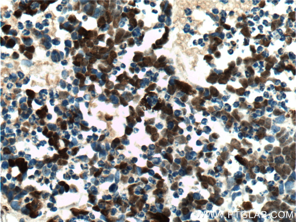 Immunohistochemistry (IHC) staining of human retinoblastoma tissue using VSX2 Polyclonal antibody (25825-1-AP)