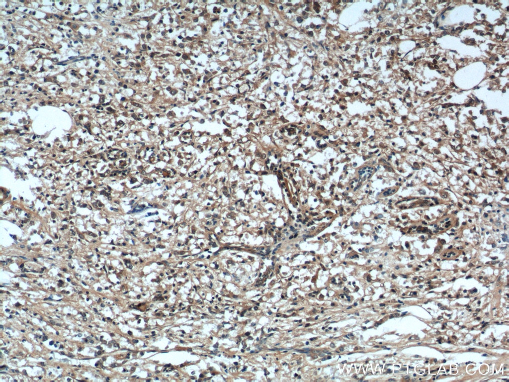 IHC staining of human breast cancer using 12080-1-AP
