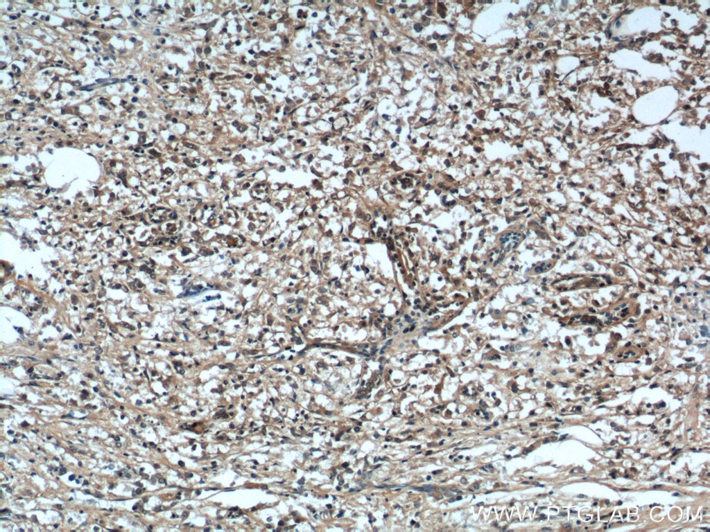 Immunohistochemistry (IHC) staining of human breast cancer tissue using B7‑H4 Polyclonal antibody (12080-1-AP)