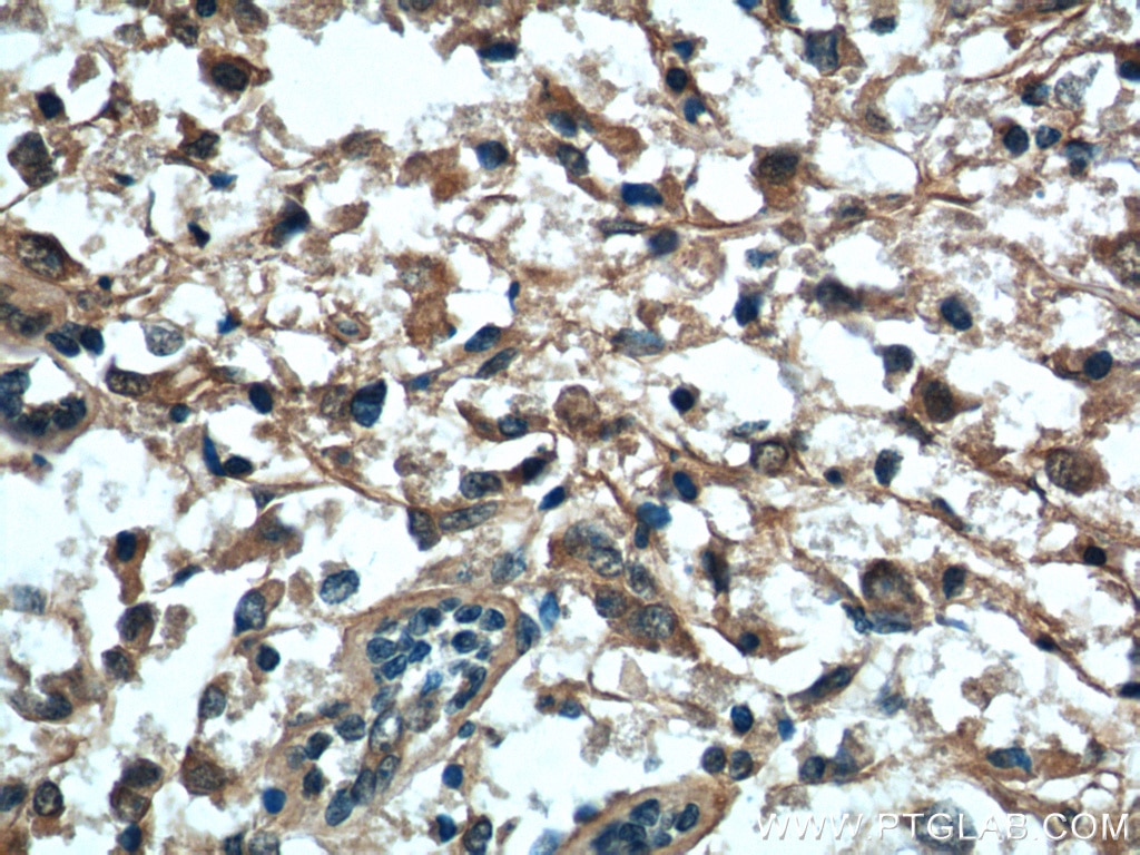 Immunohistochemistry (IHC) staining of human breast cancer tissue using B7‑H4 Polyclonal antibody (12080-1-AP)