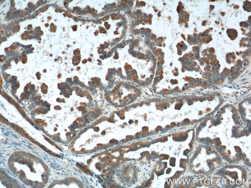Immunohistochemistry (IHC) staining of human ovary tumor tissue using B7‑H4 Polyclonal antibody (12080-1-AP)