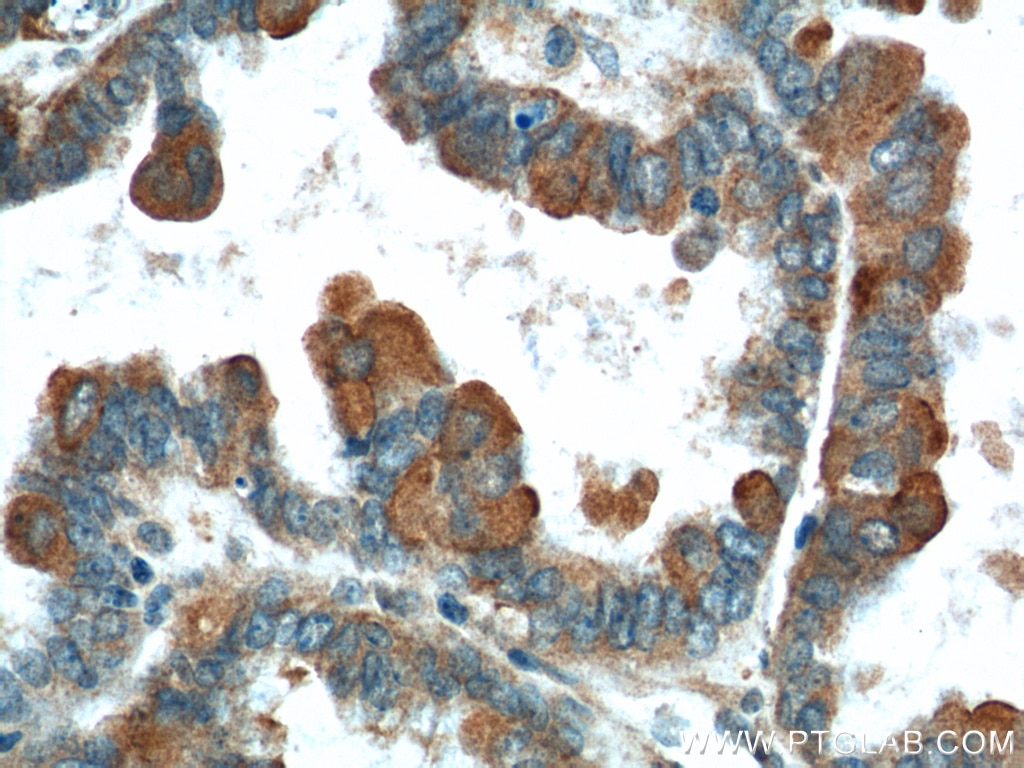 Immunohistochemistry (IHC) staining of human ovary tumor tissue using B7‑H4 Polyclonal antibody (12080-1-AP)