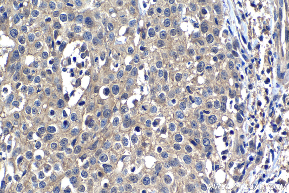 Immunohistochemistry (IHC) staining of human cervical cancer tissue using B7‑H4 Monoclonal antibody (66817-1-Ig)