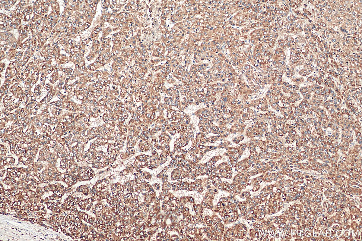 Immunohistochemistry (IHC) staining of human liver cancer tissue using VTI1B Polyclonal antibody (14495-1-AP)
