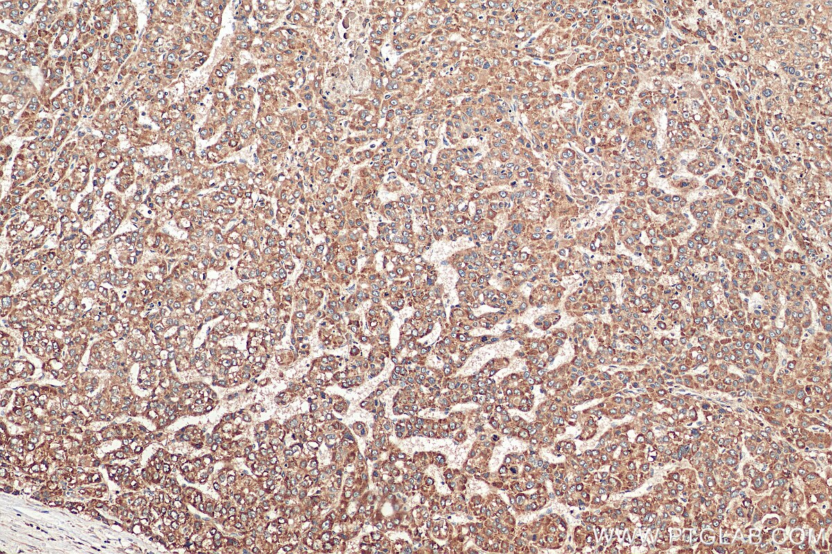 Immunohistochemistry (IHC) staining of human liver cancer tissue using VTI1B Polyclonal antibody (14495-1-AP)