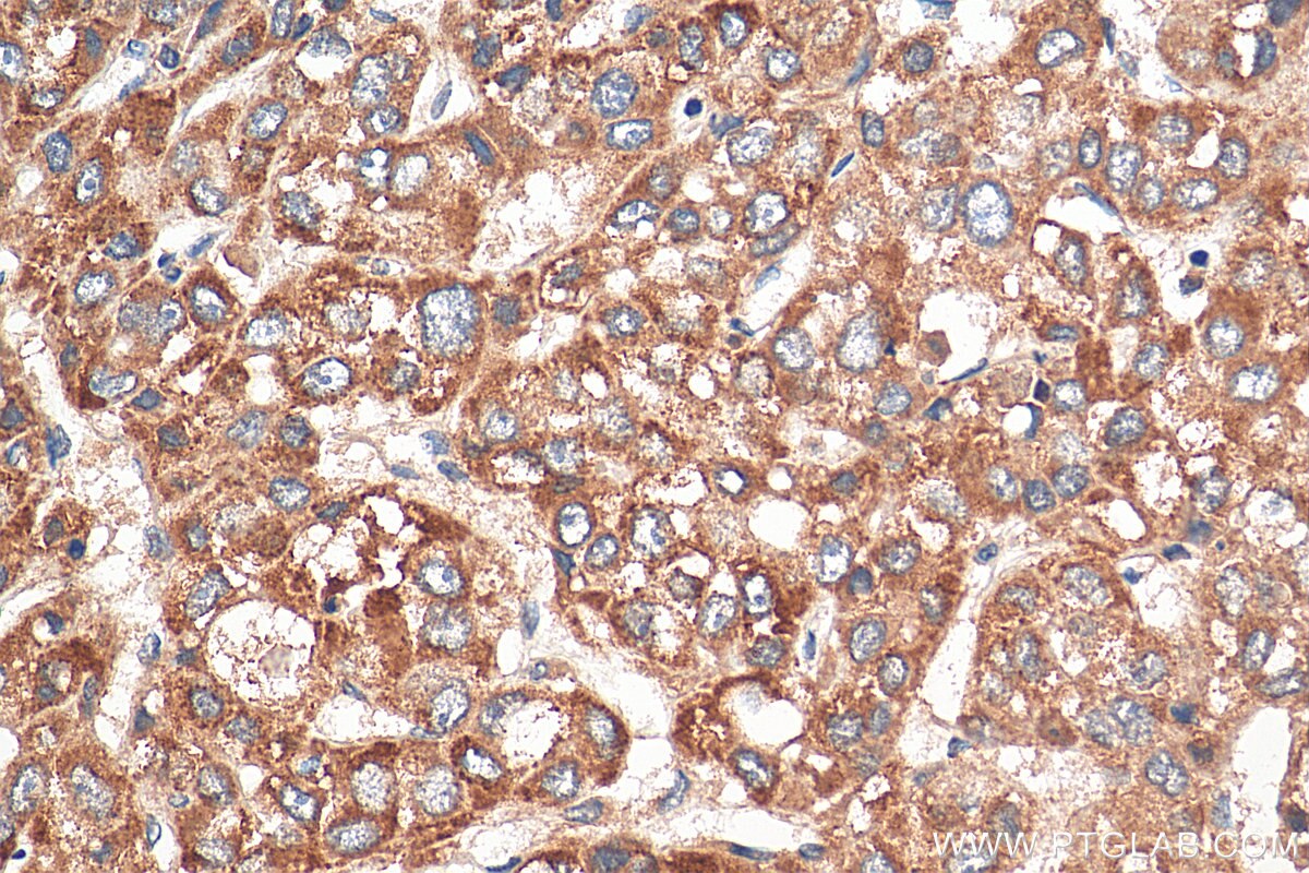 Immunohistochemistry (IHC) staining of human liver cancer tissue using VTI1B Polyclonal antibody (14495-1-AP)