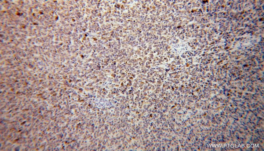 Immunohistochemistry (IHC) staining of human malignant melanoma tissue using VTI1B Polyclonal antibody (14495-1-AP)