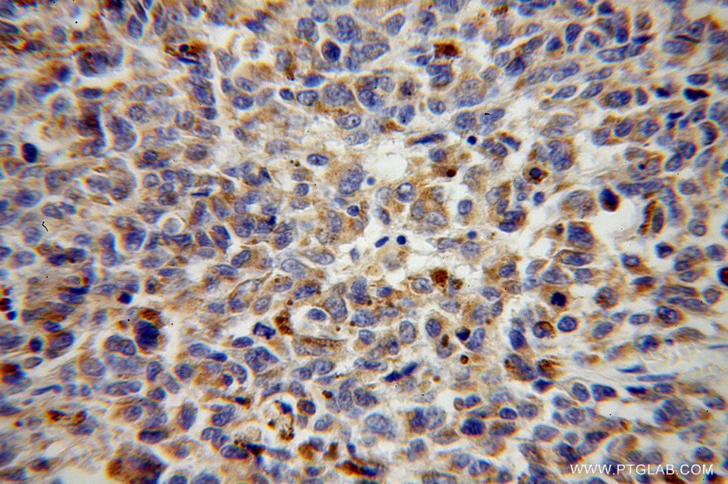Immunohistochemistry (IHC) staining of human malignant melanoma tissue using VTI1B Polyclonal antibody (14495-1-AP)