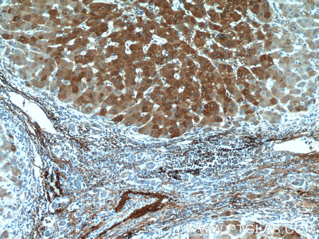 Immunohistochemistry (IHC) staining of human hepatocirrhosis tissue using Vitronectin Polyclonal antibody (15833-1-AP)