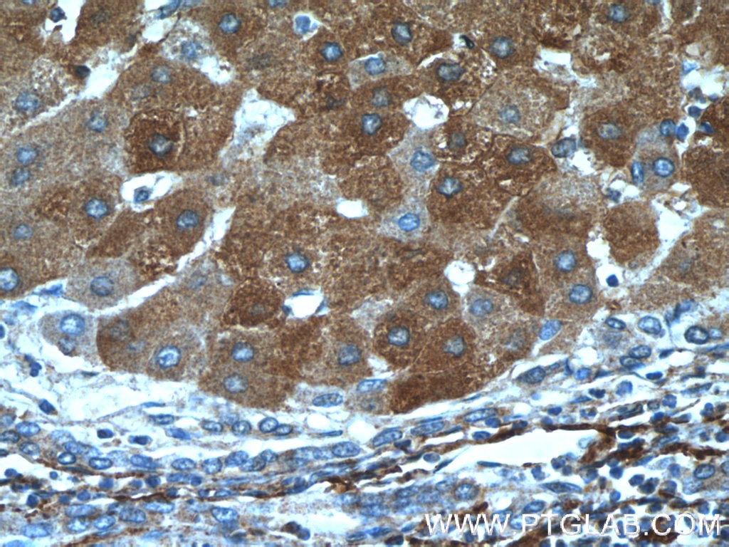 IHC staining of human hepatocirrhosis using 15833-1-AP