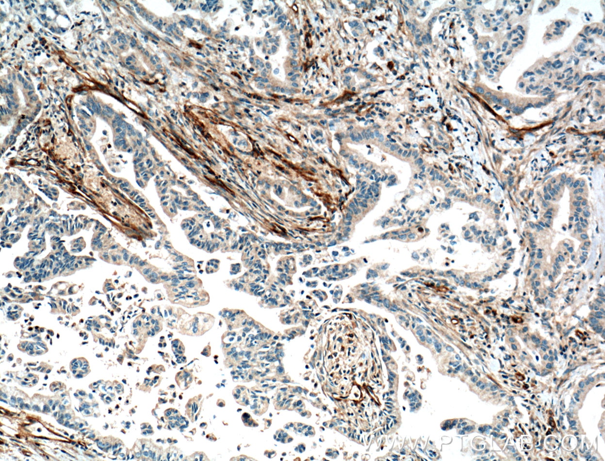 Immunohistochemistry (IHC) staining of human pancreas cancer tissue using VWA1 Polyclonal antibody (14322-1-AP)