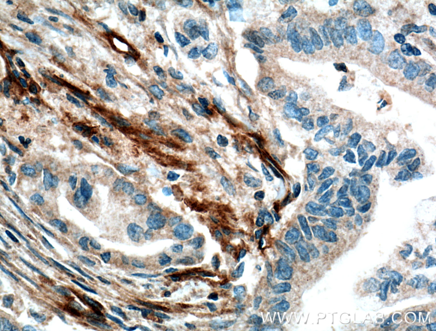 Immunohistochemistry (IHC) staining of human pancreas cancer tissue using VWA1 Polyclonal antibody (14322-1-AP)