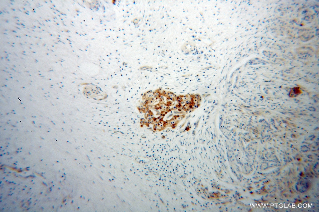 Immunohistochemistry (IHC) staining of human pancreas cancer tissue using VWA1 Polyclonal antibody (14322-1-AP)