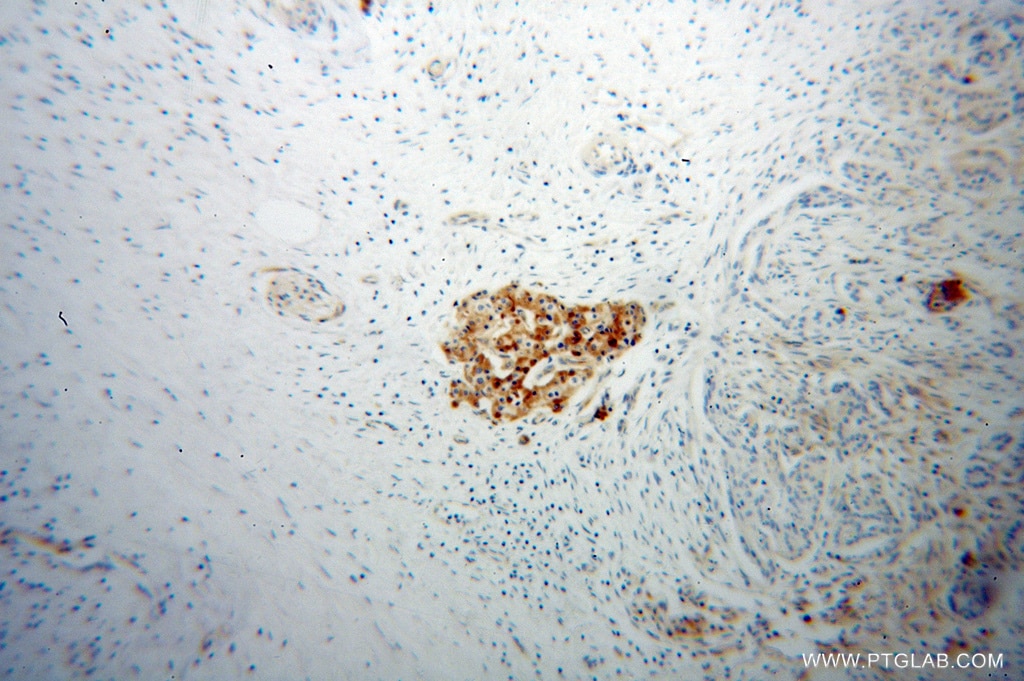 IHC staining of human pancreas cancer using 14322-1-AP