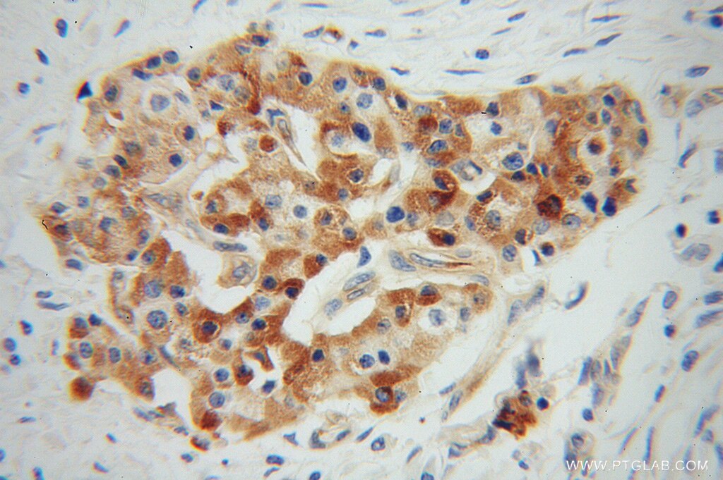 Immunohistochemistry (IHC) staining of human pancreas cancer tissue using VWA1 Polyclonal antibody (14322-1-AP)