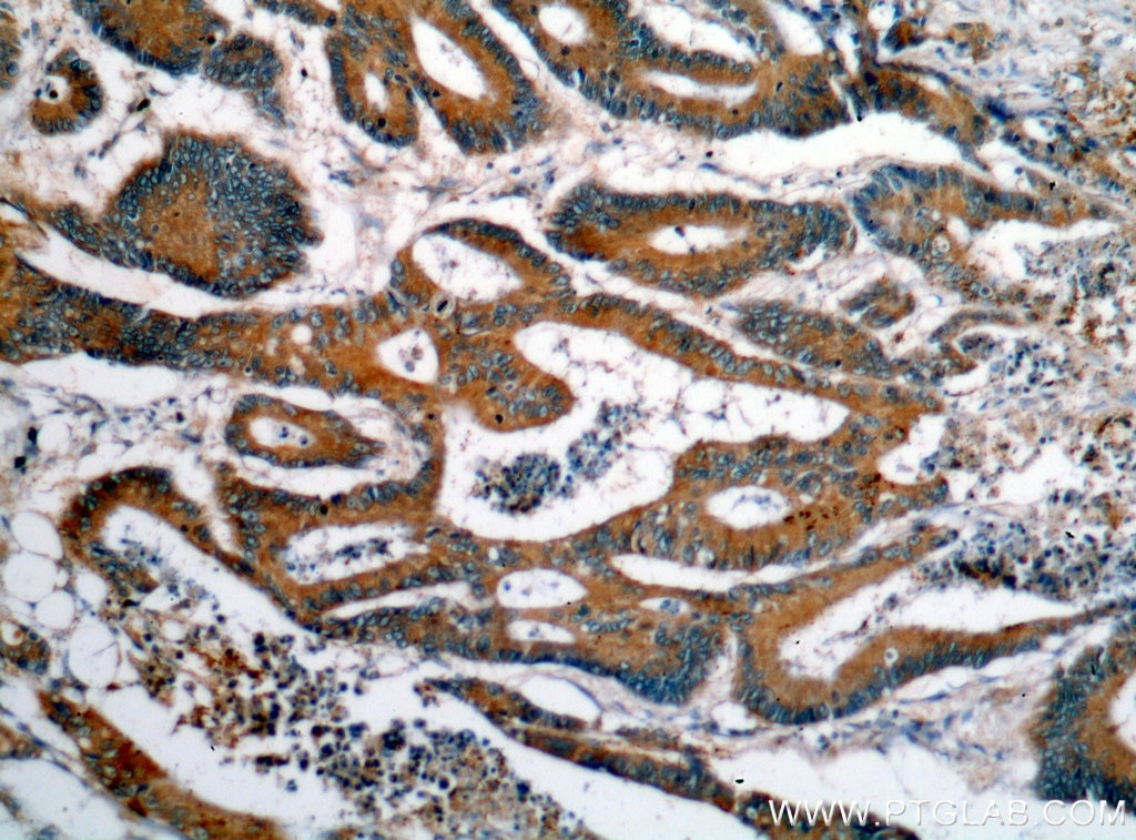 Immunohistochemistry (IHC) staining of human colon cancer tissue using VWA2 Polyclonal antibody (18714-1-AP)