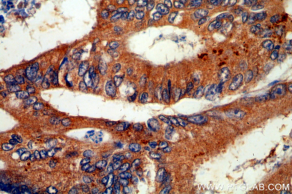 Immunohistochemistry (IHC) staining of human colon cancer tissue using VWA2 Polyclonal antibody (18714-1-AP)