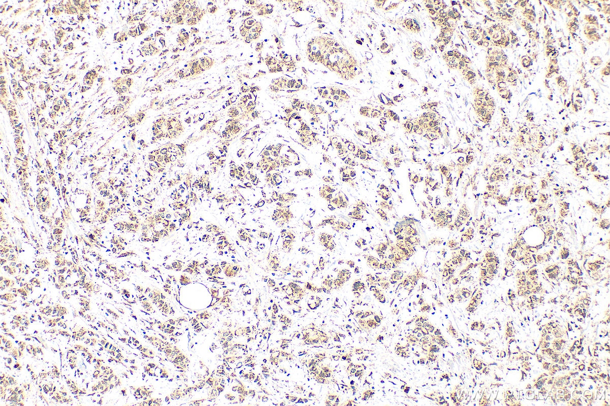 Immunohistochemistry (IHC) staining of human breast cancer tissue using VWA5A Polyclonal antibody (26175-1-AP)