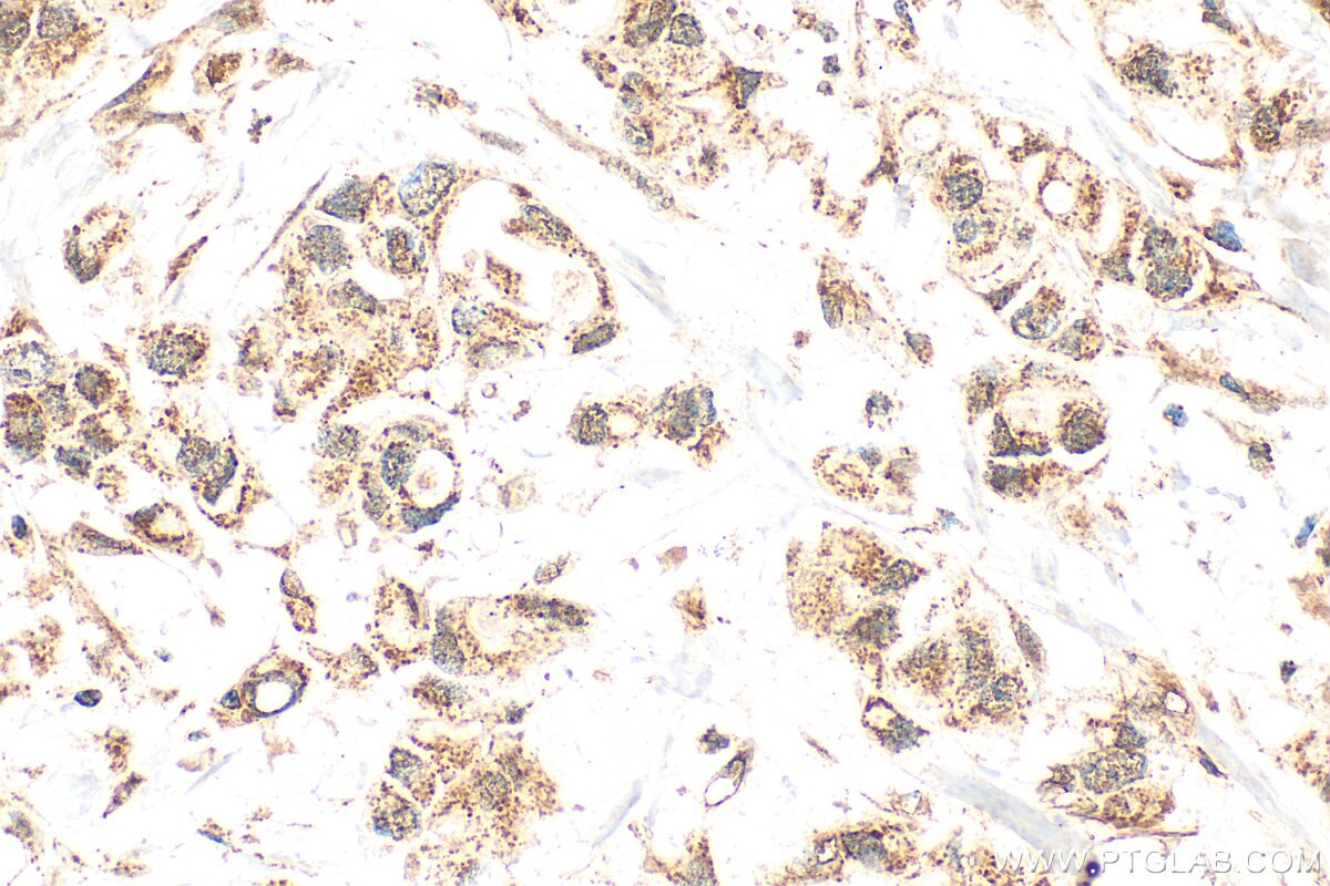 Immunohistochemistry (IHC) staining of human breast cancer tissue using VWA5A Polyclonal antibody (26175-1-AP)