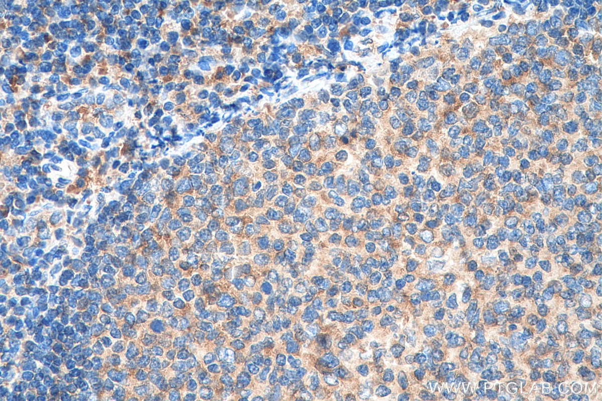 Immunohistochemistry (IHC) staining of human tonsillitis tissue using ValRS Monoclonal antibody (67935-1-Ig)