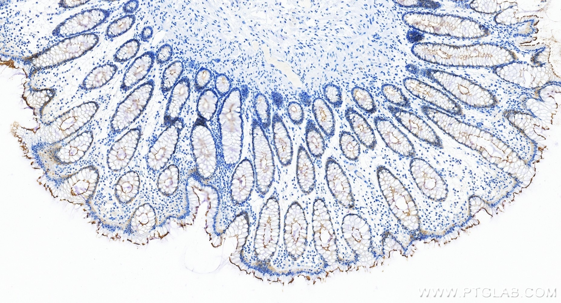 IHC staining of human colon using 86978-2-RR Immunohistochemistry (IHC) staining of human colon tissue using Villin Recombinant monoclonal antibody (86978-2-RR)