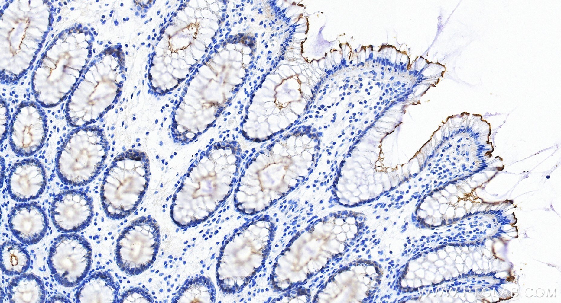 IHC staining of human colon using 86978-2-RR Immunohistochemistry (IHC) staining of human colon tissue using Villin Recombinant monoclonal antibody (86978-2-RR)