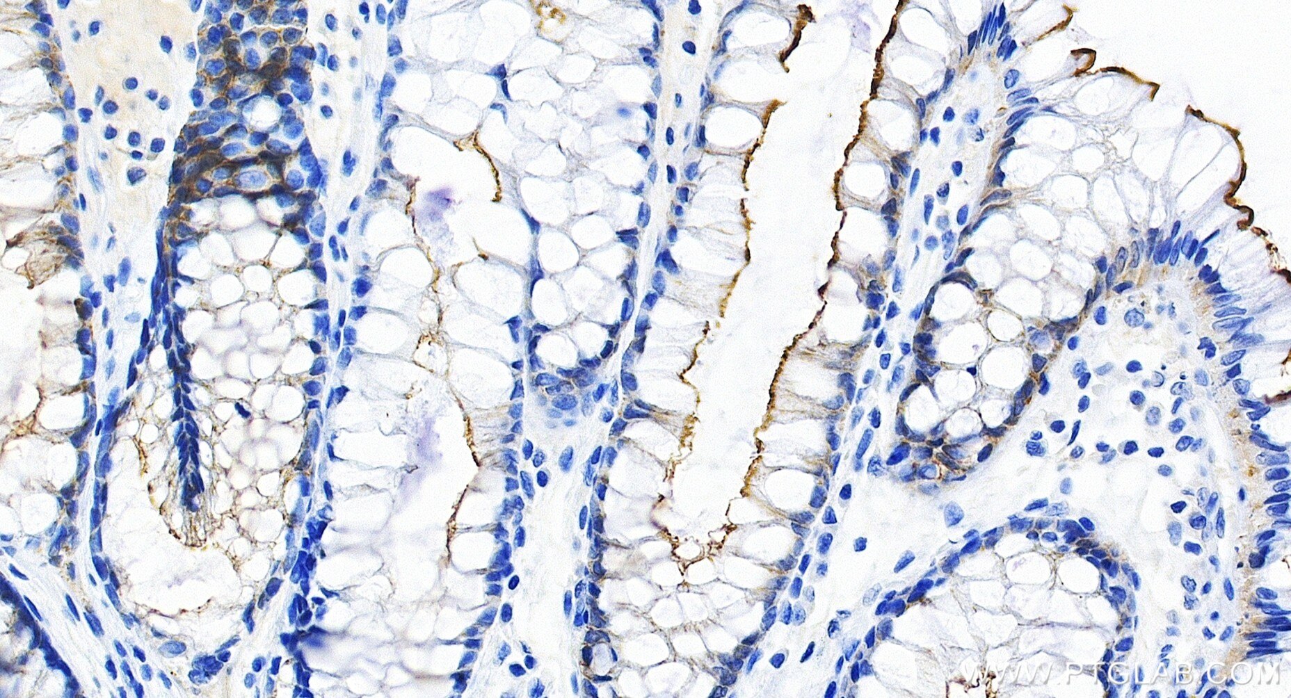 IHC staining of human colon using 86978-2-RR Immunohistochemistry (IHC) staining of human colon tissue using Villin Recombinant monoclonal antibody (86978-2-RR)