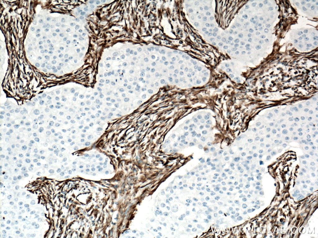 Immunohistochemistry (IHC) staining of human breast cancer tissue using Vimentin Monoclonal antibody (60330-1-Ig)