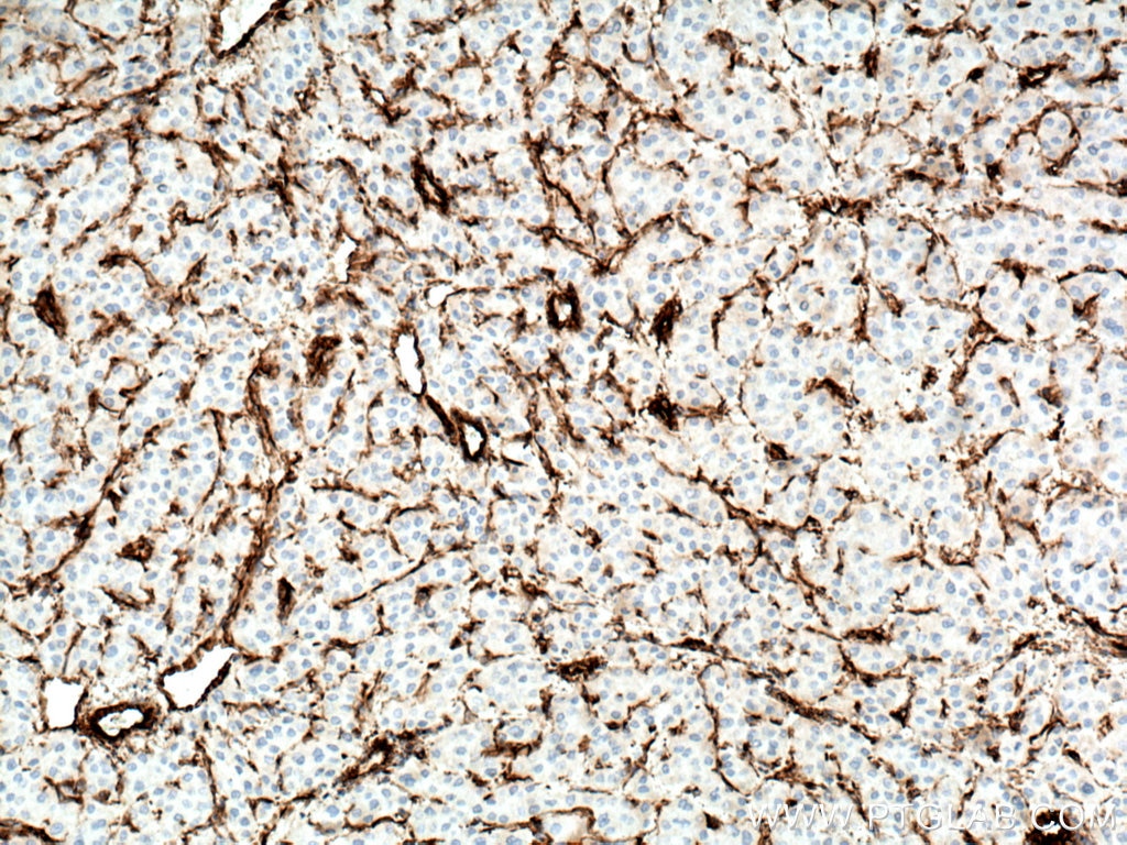 IHC staining of human liver cancer using 60330-1-Ig