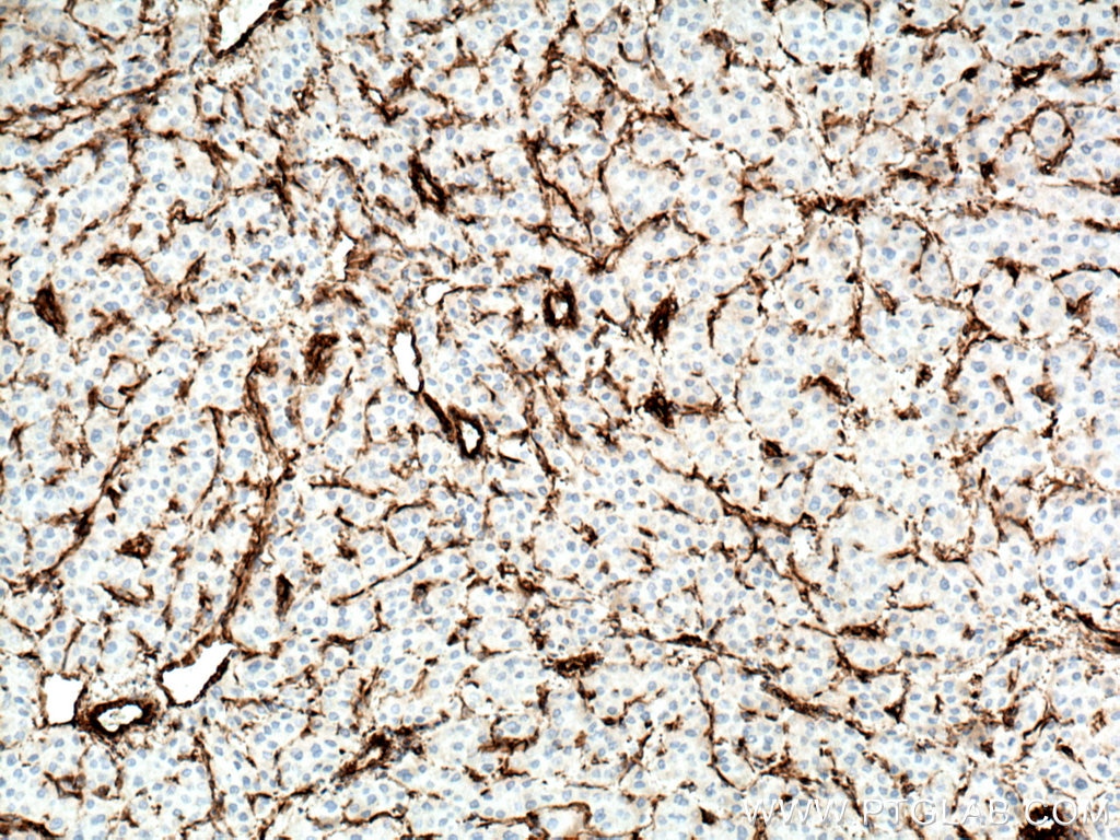 Immunohistochemistry (IHC) staining of human liver cancer tissue using Vimentin Monoclonal antibody (60330-1-Ig)