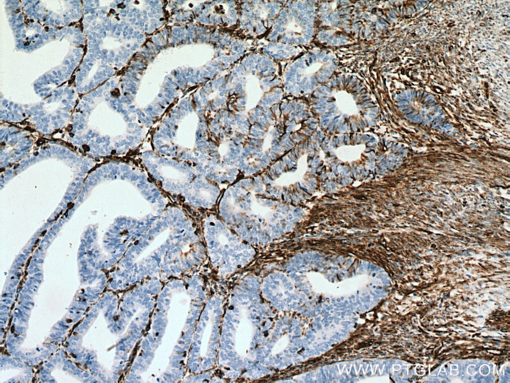 Immunohistochemistry (IHC) staining of human endometrial cancer tissue using Vimentin Monoclonal antibody (60330-1-Ig)