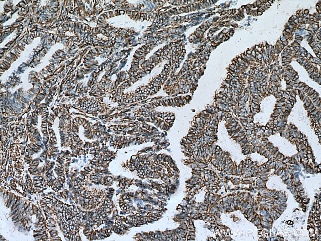 Immunohistochemistry (IHC) staining of human ovary tumor tissue using Vimentin Monoclonal antibody (60330-1-Ig)