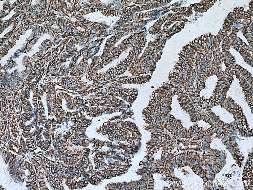 IHC staining of human ovary tumor using 60330-1-Ig