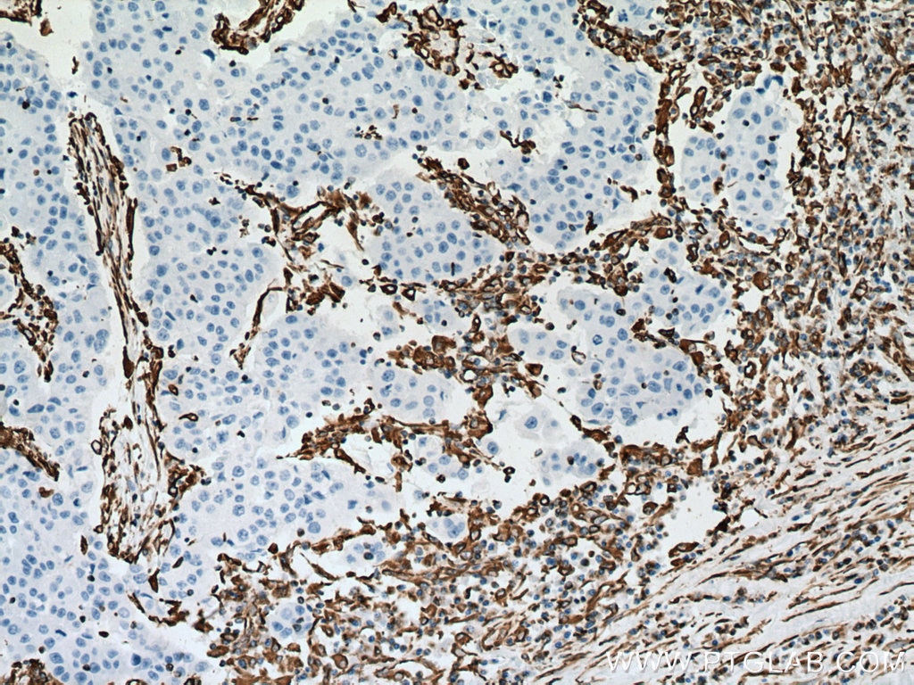 Immunohistochemistry (IHC) staining of human breast cancer tissue using Vimentin Monoclonal antibody (60330-1-Ig)