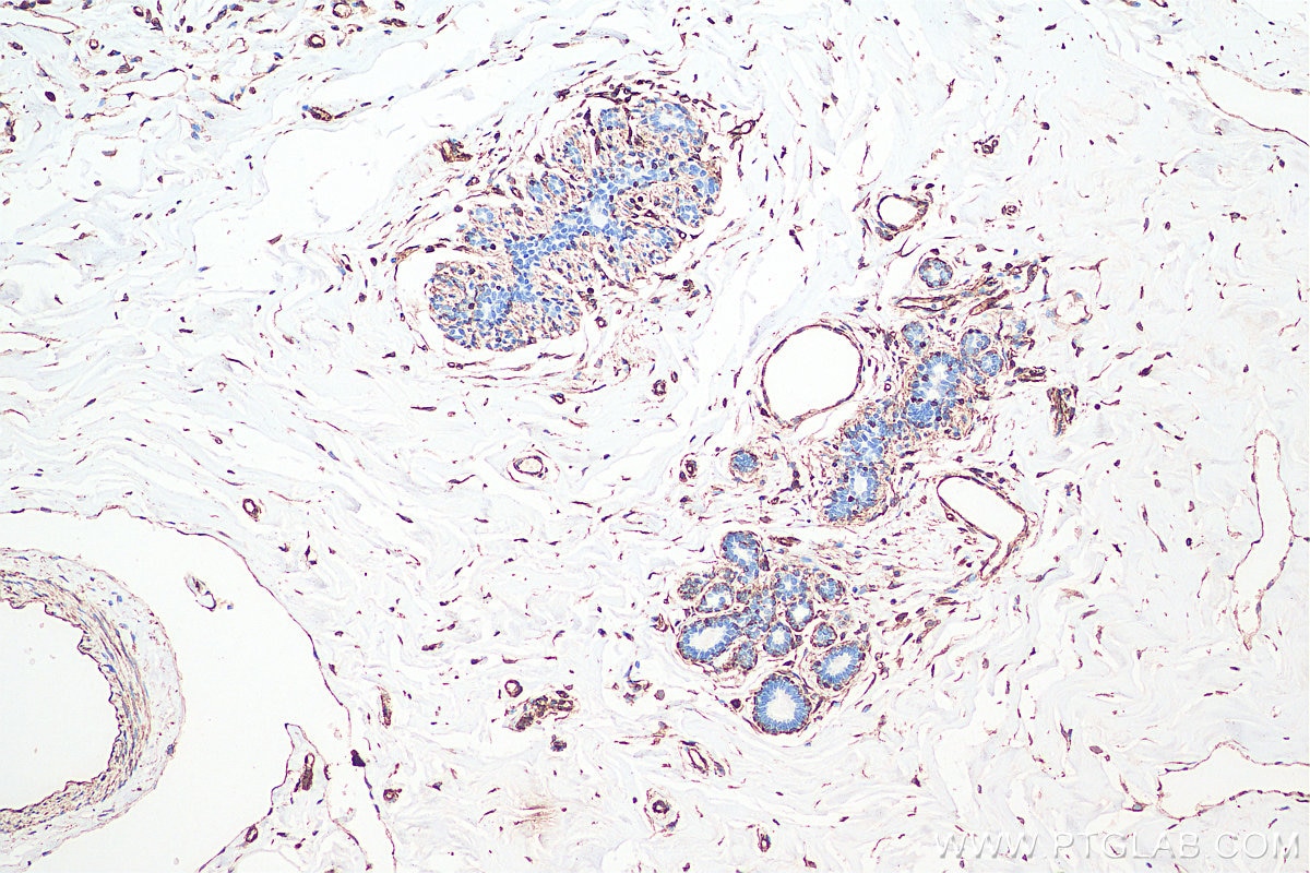 IHC staining of human breast cancer using 60330-1-Ig Immunohistochemistry (IHC) staining of human breast cancer tissue using Vimentin Monoclonal antibody (60330-1-Ig)