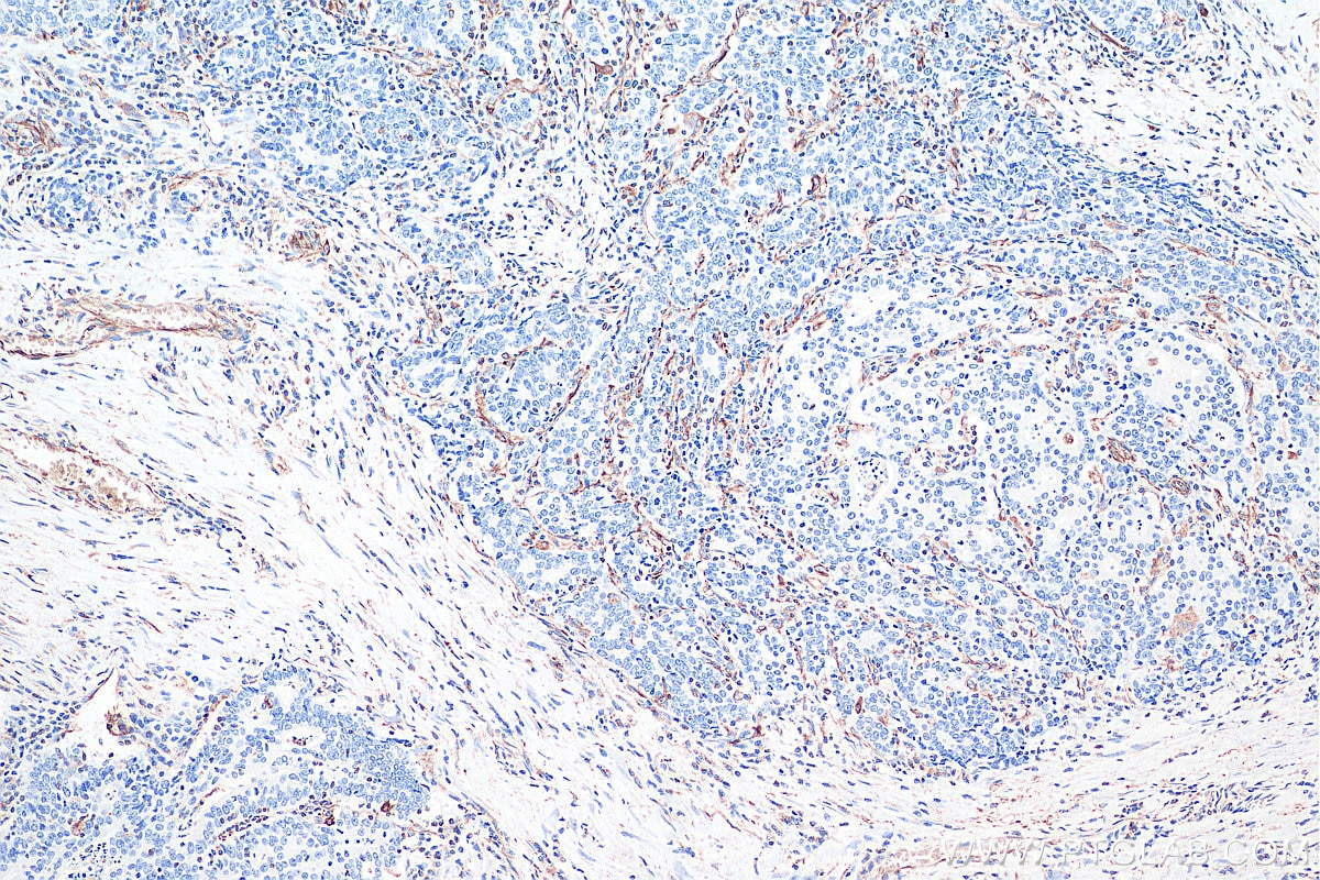 IHC staining of human colon cancer using 60330-1-Ig Immunohistochemistry (IHC) staining of human colon cancer tissue using Vimentin Monoclonal antibody (60330-1-Ig)
