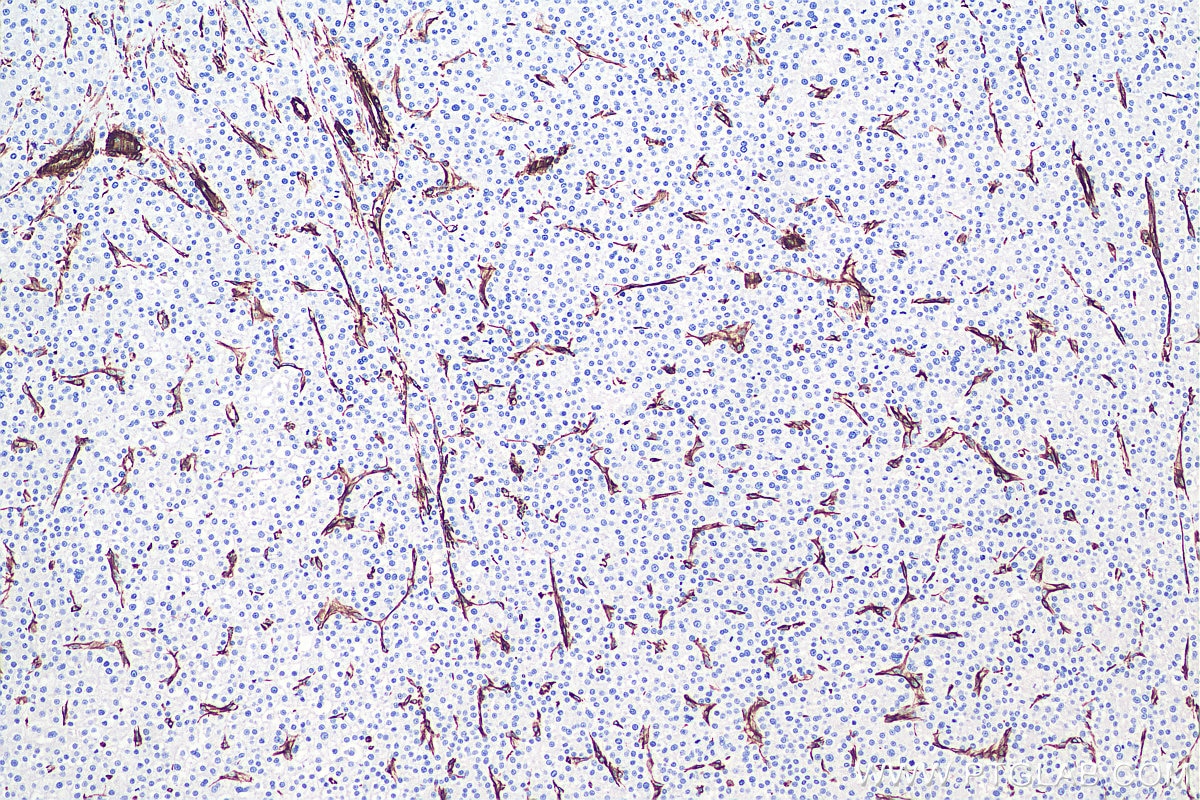 IHC staining of human liver cancer using 60330-1-Ig Immunohistochemistry (IHC) staining of human liver cancer tissue using Vimentin Monoclonal antibody (60330-1-Ig)