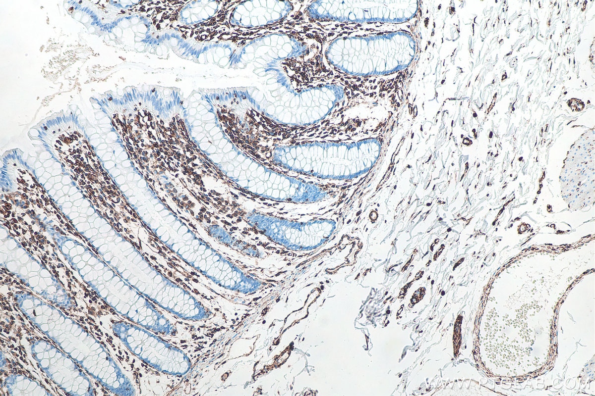 IHC staining of human colon using 60330-1-Ig Immunohistochemistry (IHC) staining of human colon tissue using Vimentin Monoclonal antibody (60330-1-Ig)