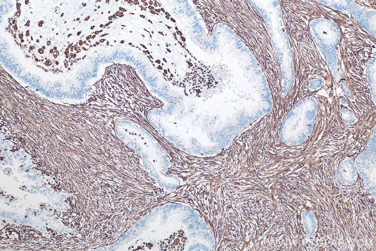 IHC staining of human pancreas cancer using 60330-1-Ig Immunohistochemistry (IHC) staining of human pancreas cancer tissue using Vimentin Monoclonal antibody (60330-1-Ig)